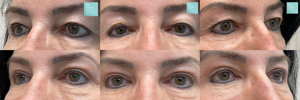 blepharoplasty before and after photos uk