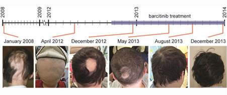 Baricitinib Alopecia Areata Treatment UK, baricitinib alopecia areata:  phase 3