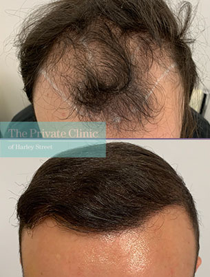 Hair Transplant surgery before and after photo uk