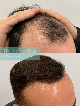 Hair Transplant surgery before and after photo uk side view