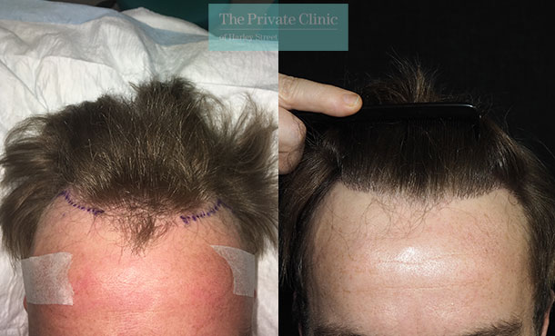 FUE Hair Transplant - 024MM-Front