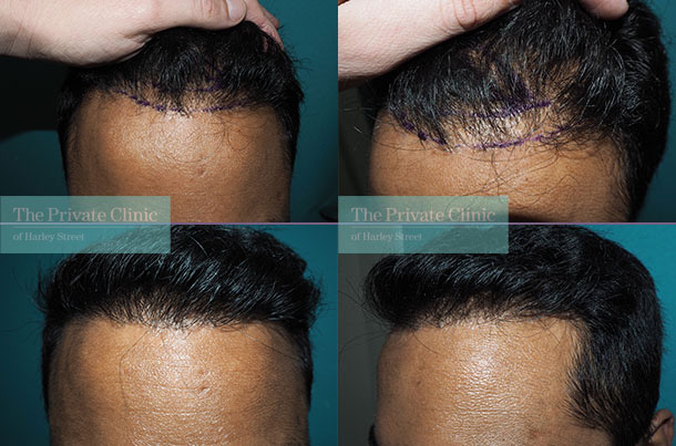 FUE hair transplant repair before after photos