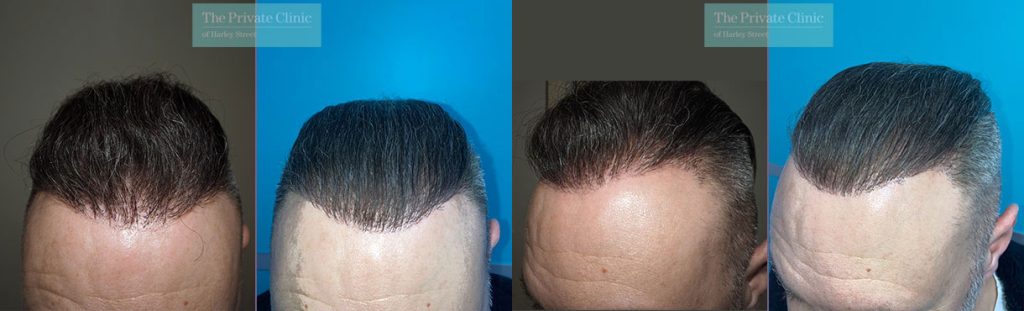 fue hair transplant scar repair before after photos