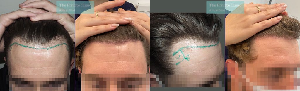 hair transplant repair temples before and after photos