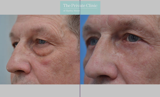 Blepharoplasty - 011AF - LSide