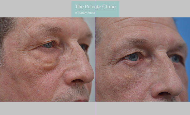 Blepharoplasty - 011AF - RSide