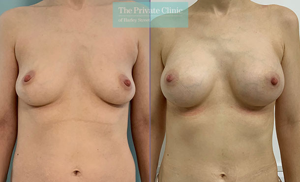 Breast Augmentation - 021DF