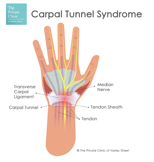 carpal-tunnel-syndrome-hand-pain