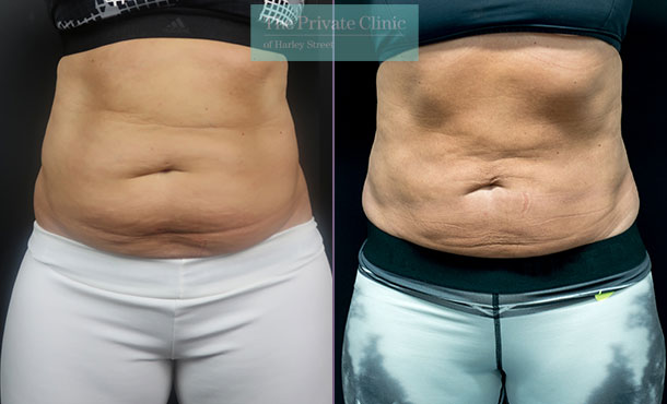 CoolSculpting - 004CSC-Front