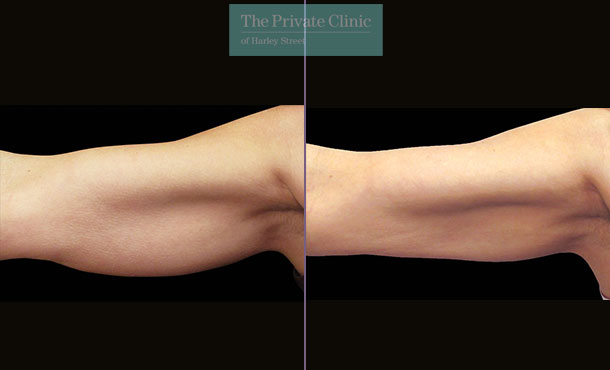 CoolSculpting - 018CP