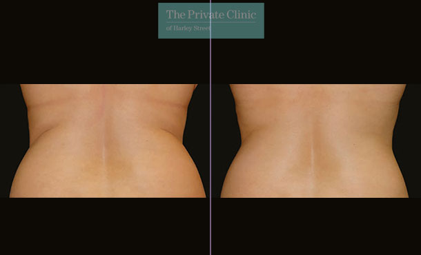 CoolSculpting - 006CP