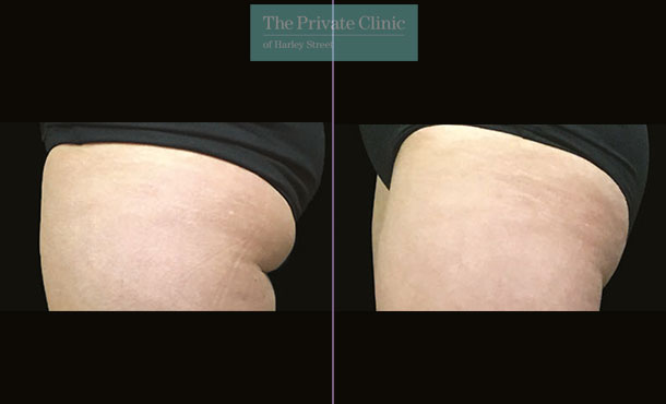 CoolSculpting - 004CP-Side