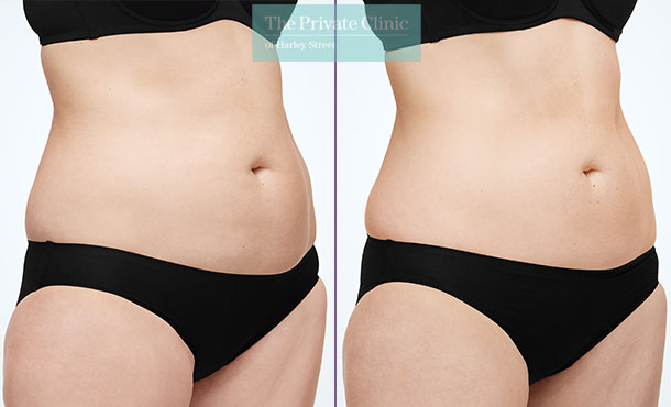 CoolSculpting - 015CP-Angle