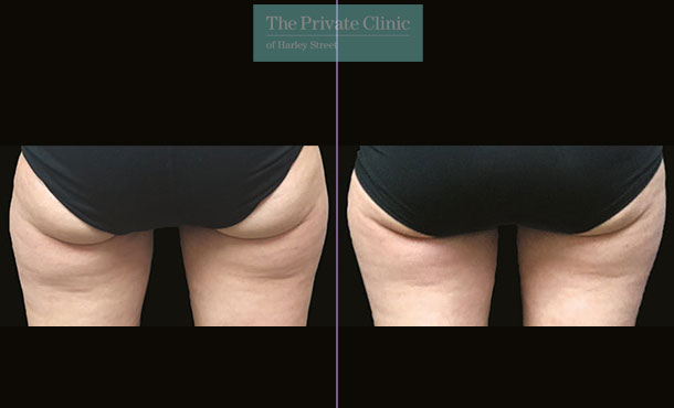 CoolSculpting - 004CP-Back