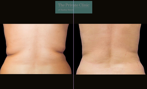 CoolSculpting - Before & After Images - The Private Clinic of Harley Street  London