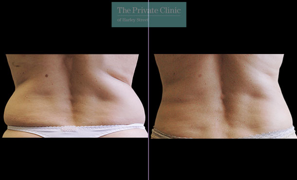 CoolSculpting - 027CP