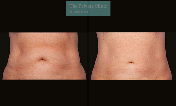 CoolSculpting - 003CP