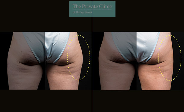 CoolSculpting - 020CP