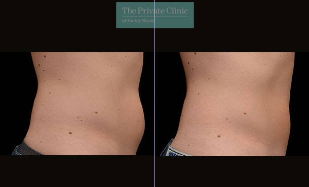 CoolSculpting - 022CP