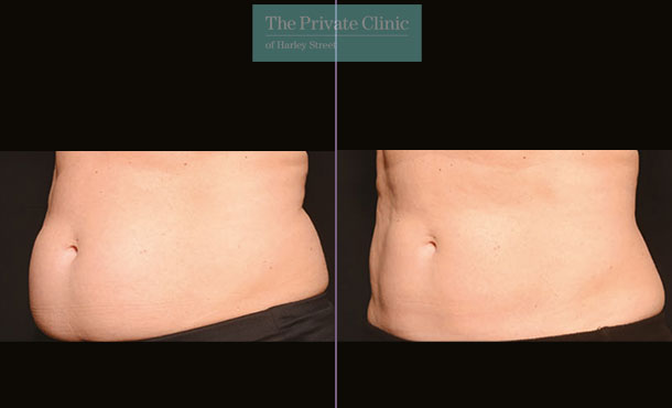 CoolSculpting - 001CP-Side