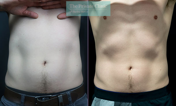 CoolSculpting for Men  Learn About Bodysculpting for Guys