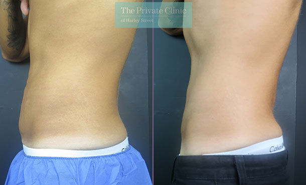 CoolSculpting - 005CSC-Side