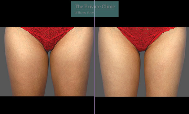 CoolSculpting - 032CP