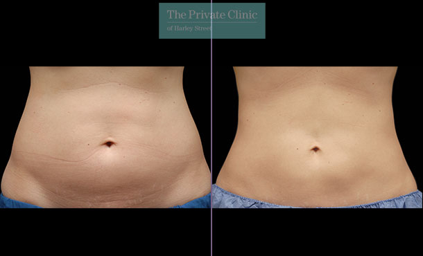 CoolSculpting - 029CP