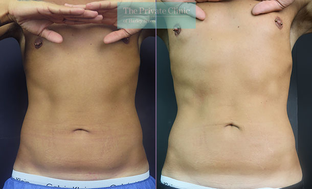 CoolSculpting - 005CSC-Front