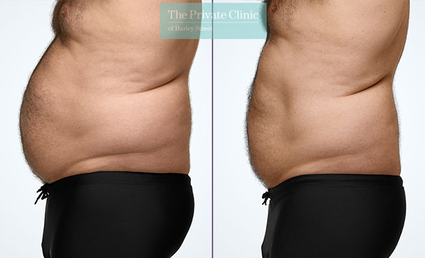 CoolSculpting - 013CP