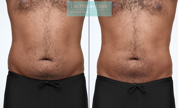 CoolSculpting - 014CP-Front