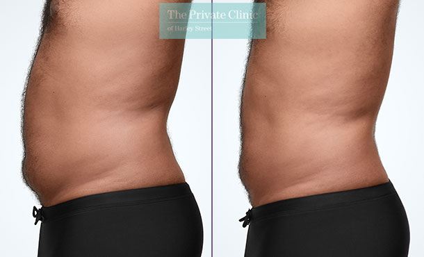 CoolSculpting - 014CP-Side