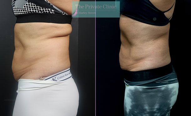 CoolSculpting - 004CSC-Side