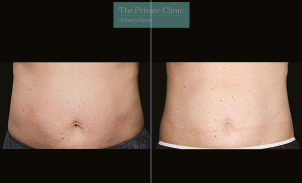 CoolSculpting - 002CP