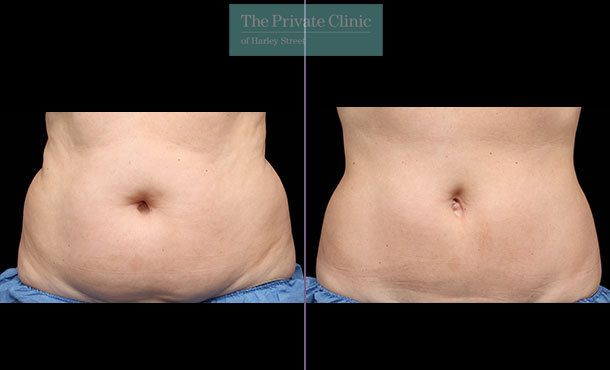 Fat Freezing  CoolSculpting UK, non invasive fat reduction