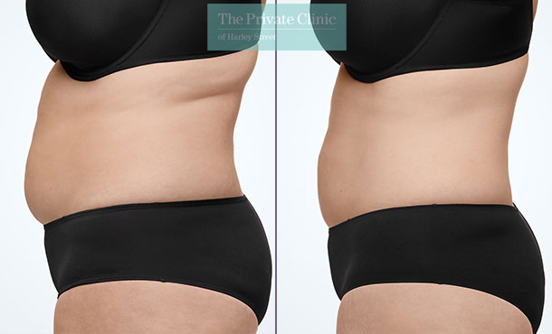 CoolSculpting - 016CP-Side