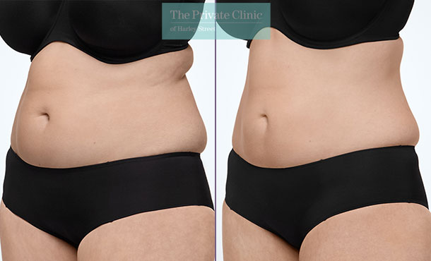 CoolSculpting - 016CP-Angle