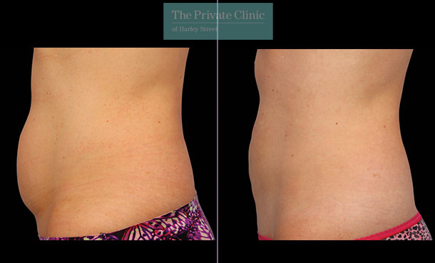 CoolSculpting - 031CP-Side