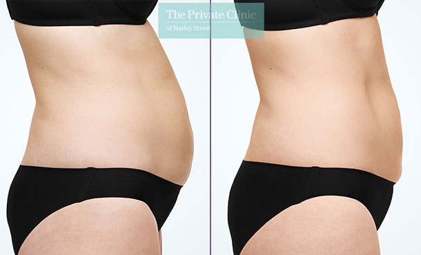 CoolSculpting - 015CP-Side