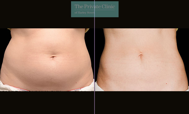 CoolSculpting - 021CP