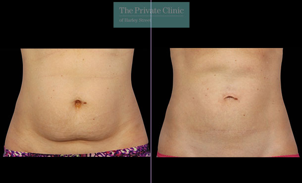 CoolSculpting - 031CP-Front