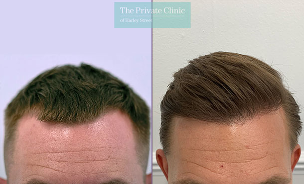 Hair Transplant - 020FR - Front