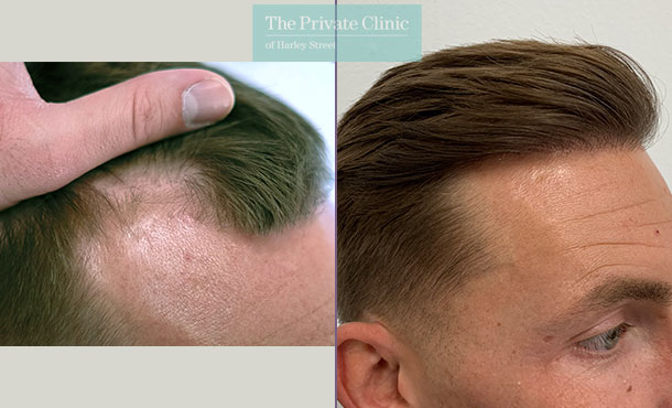 Hair Transplant - 020FR - Side