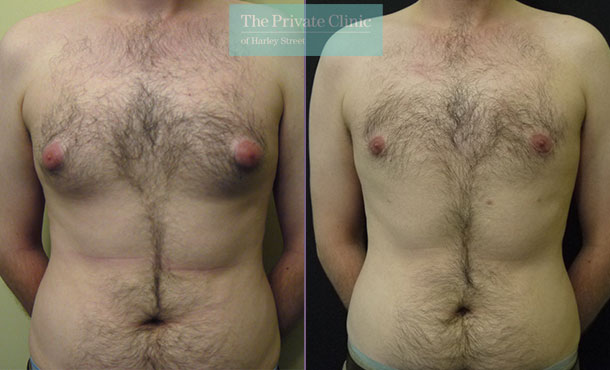 Male Chest Reduction - 001MB-Front