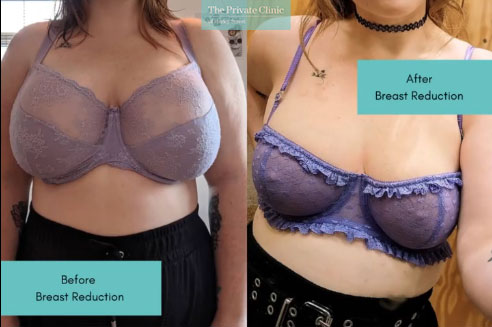 Breast Reduction young women before and after photo results decrease cup size from 34HH
