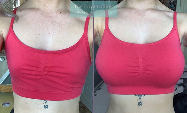 Breast augmentation 23 years old before and after photo results