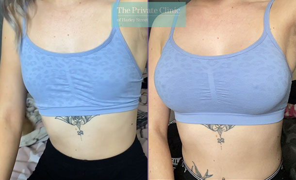23 years old chloe boob job experience before and after photo results