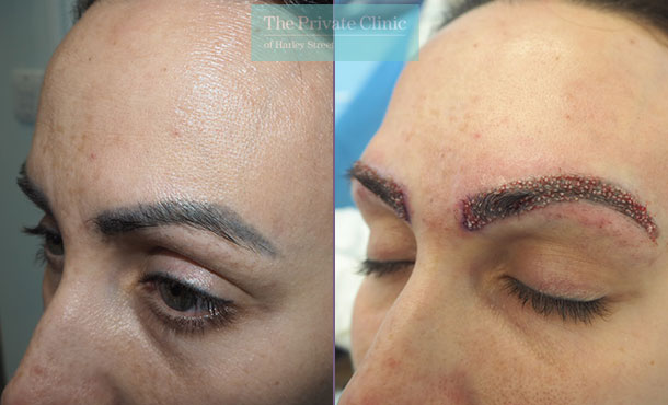 eyebrow tattooing, microblading