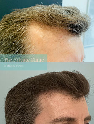 FUE Hair Transplant Clinic Manchester, Hair Restoration Surgery