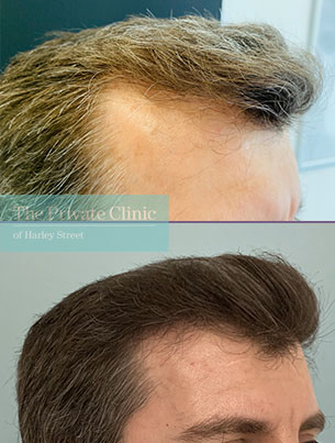 FUE Hair Transplant Results before and after results